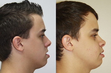 Clockwise Face Rotation and Chin Recontouring profile view
