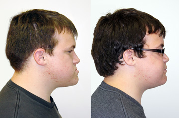 Face, Airway, and Bite Correction profile view no smile