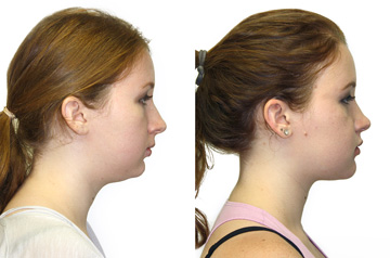 Corrective Jaw Surgery Case Profile No Smile