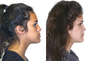 Face, airway, and bite correction surgery case profile view no smile lipps together