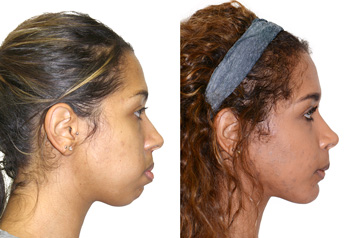 Face asymmetry correction picture before and after