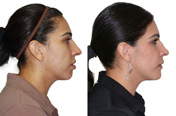 Corrective jaw surgery bite correction and cheek implants profile view no smile