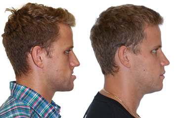 Corrective jaw surgery and bite correction profile view no smile