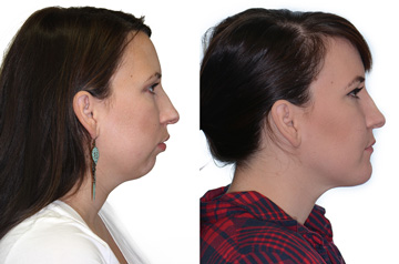 Corrective jaw surgery, chin asymmetry, and bite correction profile view no smile