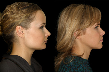 Face, Airway, and Bite Correction profile view