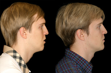 Contouring of the mandibular body profile view