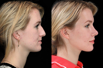 Upper and lower jaw advancement with lipofilling profile view with no smile
