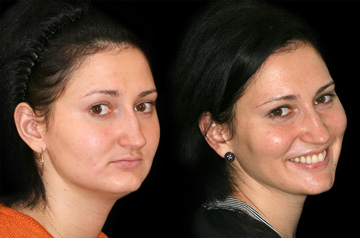 Contouring of the mandibular body profile view