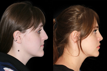 Photographs of the patient orthognathic surgery profile view Before and After with no smile