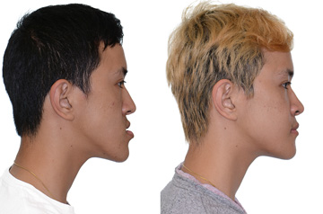 Photographs of the orthognathic surgery patient profile view with no smile