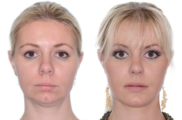Photographs of the orthognathic surgery patient frontal view with no smile before and after